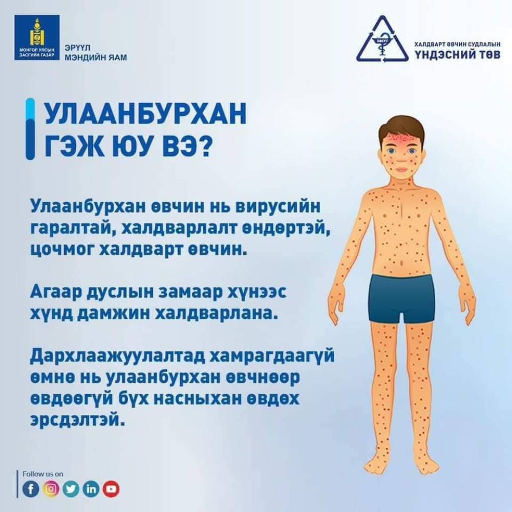 Улаанбурхан өвчнөөс өөрийгөө болон бусдыг хамгаалъя